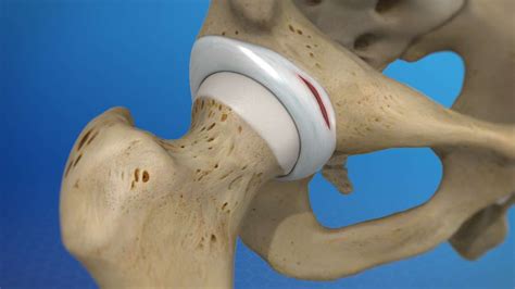 acetabular labral tear surgery recovery